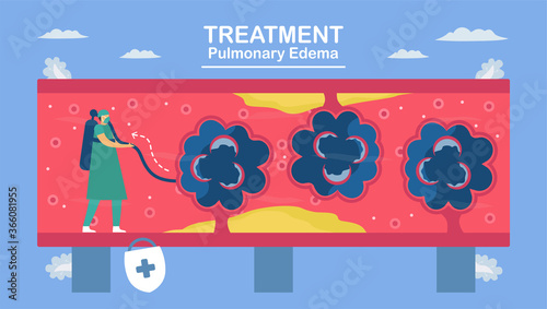 Pulmonary edema is symptom that lungs fill with fluid. Treatment and diagnostic. Body struggles to get enough oxygen until shortness of breath.