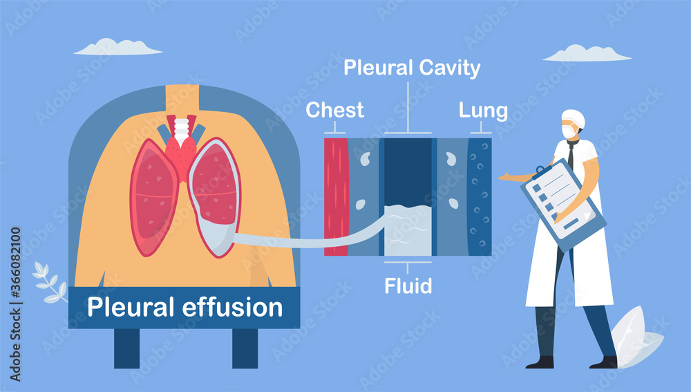 Pleural effusion is collection of excess fluid between layers of pleura