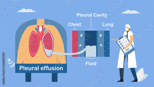 Pleural effusion is collection of excess fluid between layers of pleura outside lungs. Pulmonology vector illustration about restrictive lung disease.