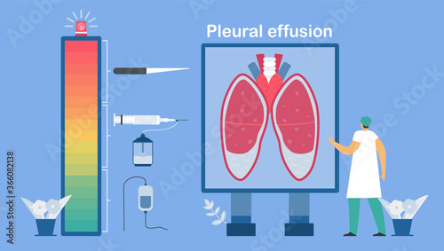 Level of treatments. Pleural effusion is collection of excess fluid between layers of pleura outside lungs. Pulmonology vector illustration about restrictive lung disease.