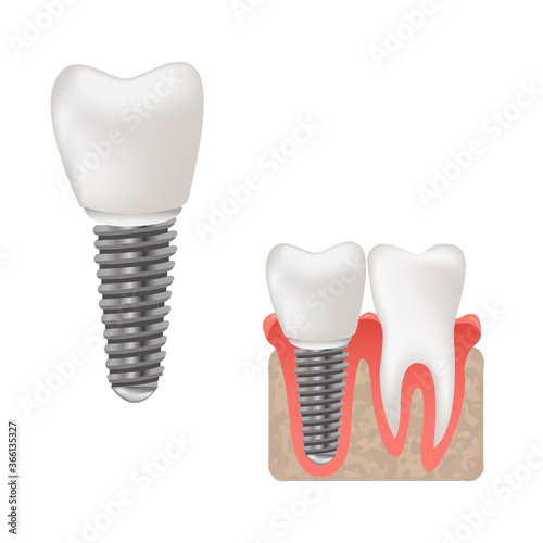 Dental implant and healthy teeth scientific modern design, realistic vector illustration