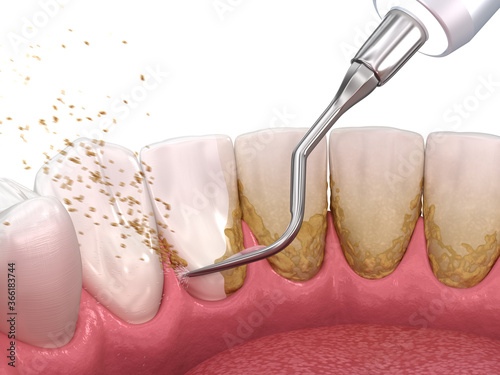 Oral hygiene: Scaling and root planing (conventional periodontal therapy). Medically accurate 3D illustration of human teeth treatment photo