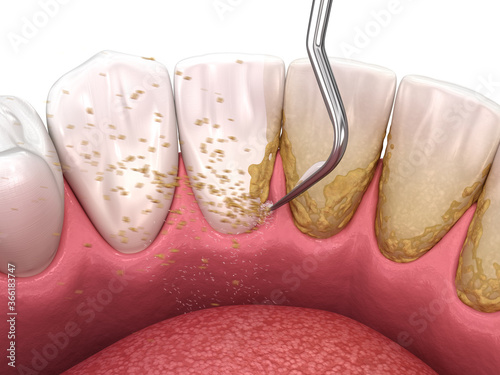 Oral hygiene: Scaling and root planing (conventional periodontal therapy). Medically accurate 3D illustration of human teeth treatment