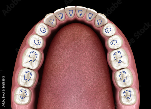 Root canal orifice locations plan of mandible jaw. 3D illustration