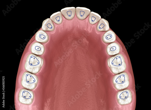 Root canal orifice locations plan of maxillary jaw. 3D illustration