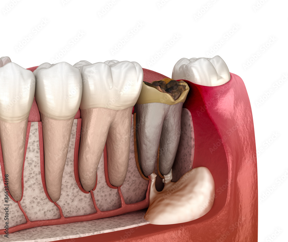 Periostitis tooth Lump on Gum Above Tooth. Medically accurate dental