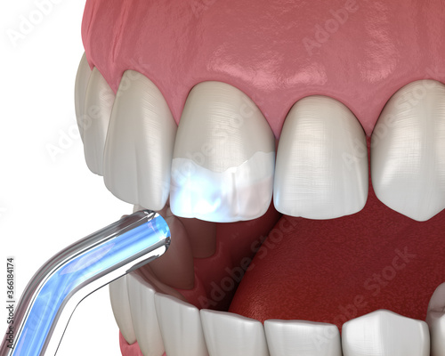 Tooth restoration with filling and polymerization lamp. Medically accurate tooth 3D illustration.