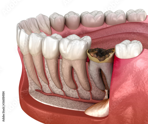 Canvastavla Periostitis tooth - Lump on Gum Above Tooth