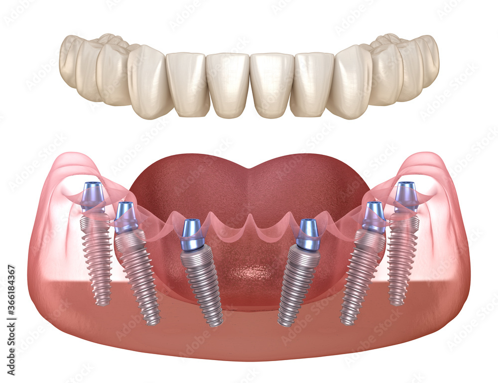 Mandibular Prosthesis With Gum All On 6 System Supported By Implants ...