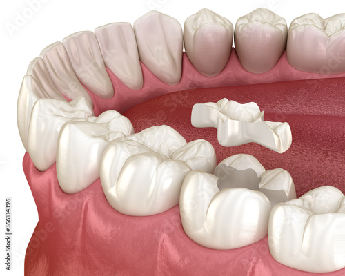 Slika na platnu Inlay ceramic crown installation in to the tooth
