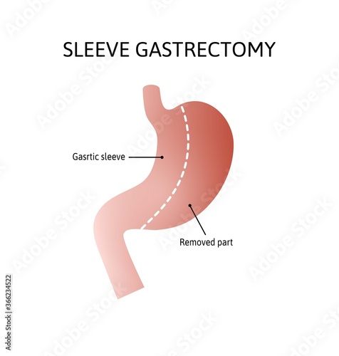 Vertical Sleeve Gastrectomy. Human stomach anatomy isolated on white background. decrease in stomach volume. vector illustration marked with lines.