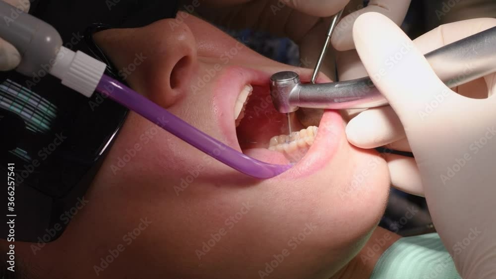 Drilling teeth and sucking saliva with ejector. Young woman at dental clinic. Female dentist with assistant treating cavities in a patient mouth in modern dental office.