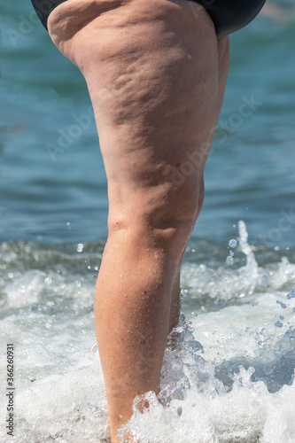 cellulite on women's thighs and legs photo