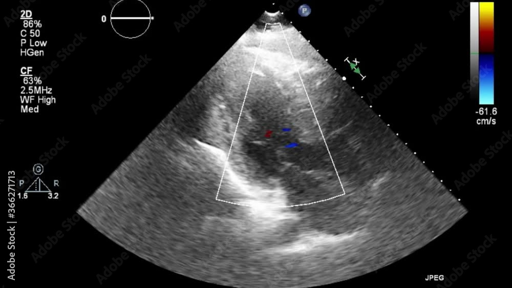 Transesophageal ultrasound video in gray-scale mode.