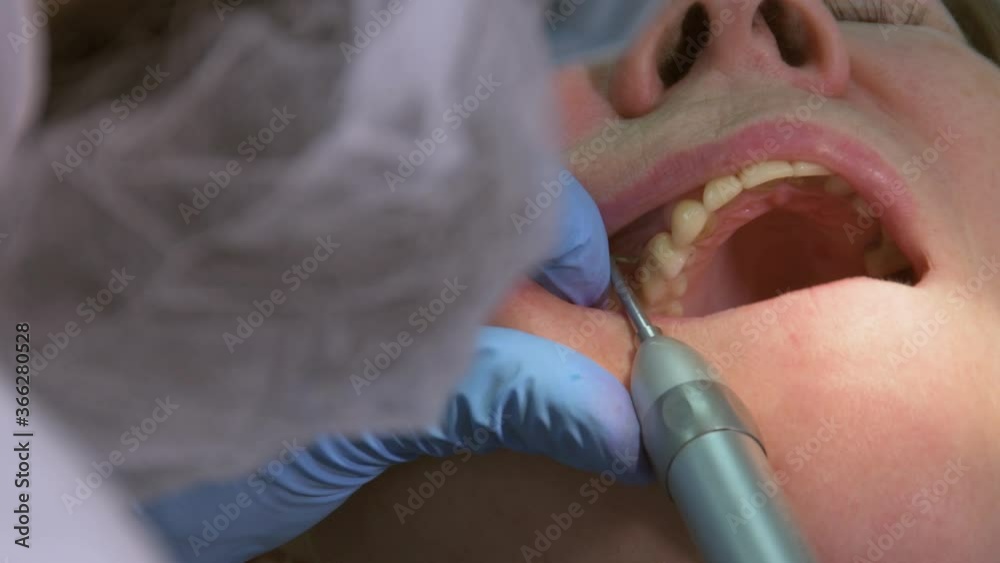 Oral surgeon removing new crowns or artificial teeth on installed implants and abutments in
