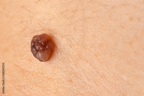 Mole birthmark nevus macro photo on human skin. Close up.