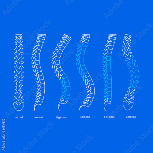 Osteoporosis Bone Types Infographics Concept Card Poster Contour Linear Style. Vector