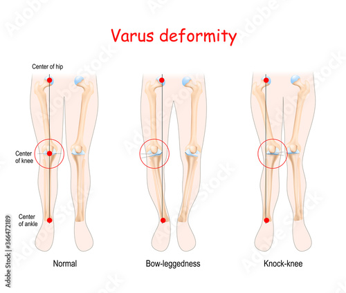 Foto valgus deformities. healthy joint, knock-knee and Bow-leggedness.