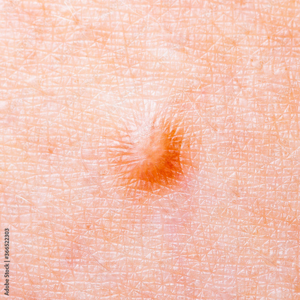 Skin Mole Defect High Magnification Macro Photo for Medical Diagnosis ...