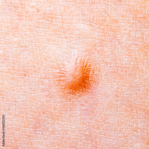 Skin Mole Defect High Magnification Macro Photo for Medical Diagnosis