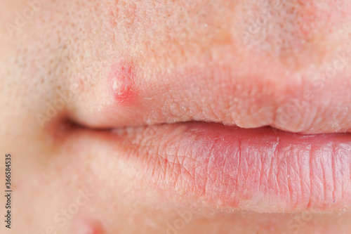 Obraz na płótnie big red acne on the lip, macro shot