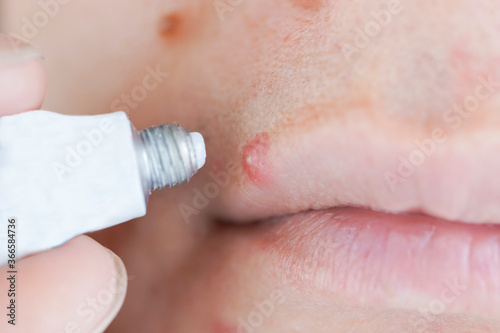A tube of cream next to a large red acne on the lip. close-up shot