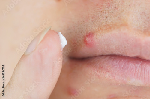 big red acne on the lip, macro shot