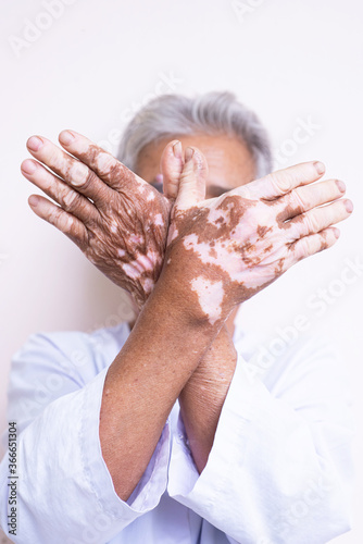 Vitiligo on the hands of old people