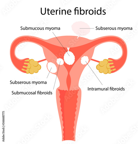 Vector illustration of uterine fibroids. 