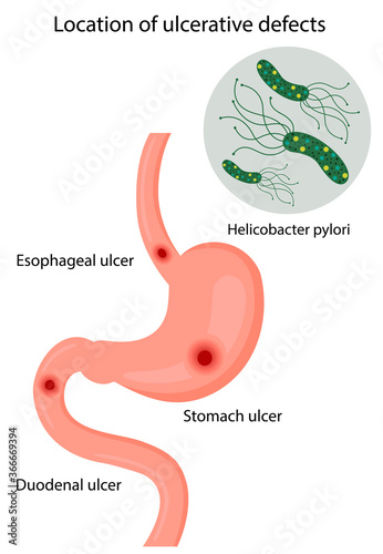 Vector illustration of the location of ulcerative defects