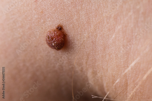 Closeup brown mole on caucasian woman skin.