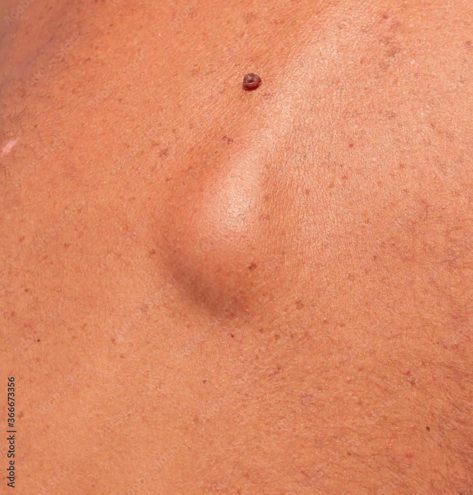 Fototapeta premium lump hernia on the skin of the back