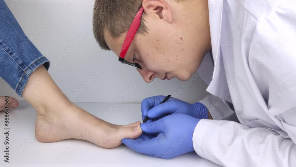 A dermatologist cleans a nail affected by a fungus. Antimycotic therapy