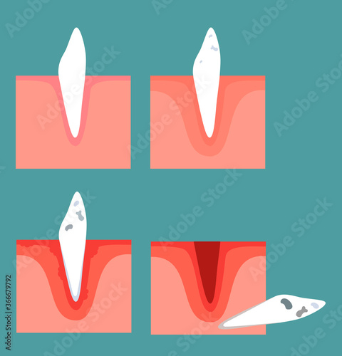 Stages of tooth decay