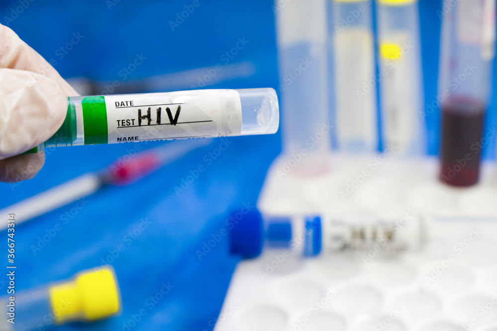 HIV and aids infection test, doctors face and hand holding tube with blood on the blue background. HIV and aids infection test, doctors face and hand holding tube with blood on the blue background.