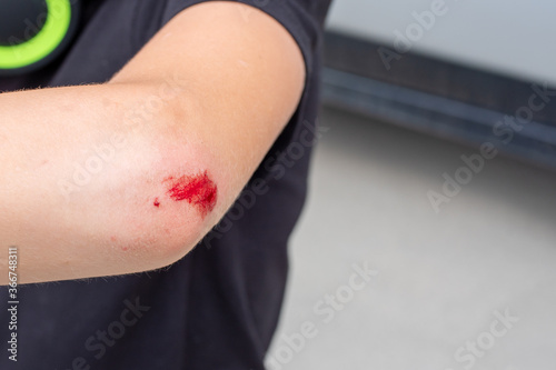 Selective focus of a fresh wound on the arm, elbow with blood. Health medical concept. Copy space