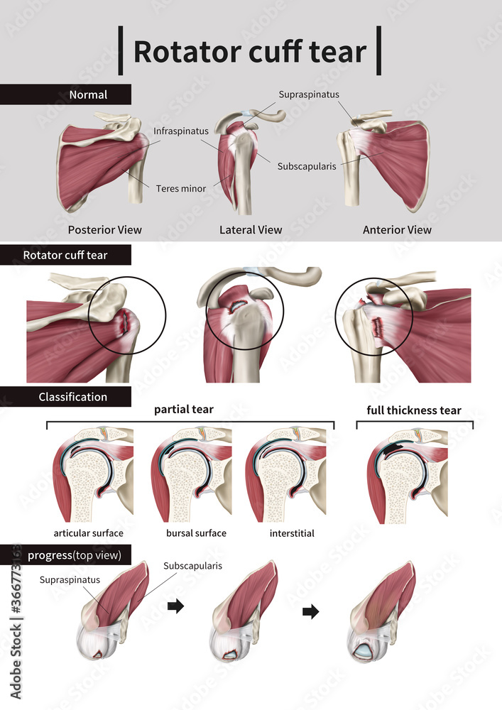 Medical illustration explaining rotator cuff tear Stock Illustration ...