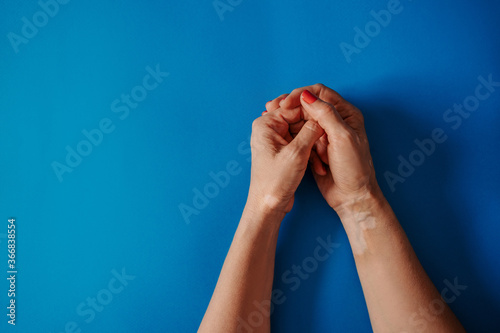 female hands with vitiligo on a blue background. Self love. Skin disease on palms. Body positive, depifmentation disease. World vitiligo day.