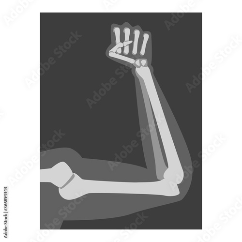 Roentgenograph of Forearm Front View Vector Image