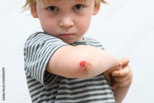 boy kid arm accident wound he painful abrasion scratches from fall, medical health concept