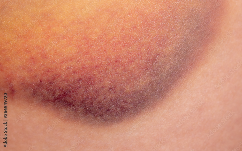 Closeup bruise on human skin as a background.