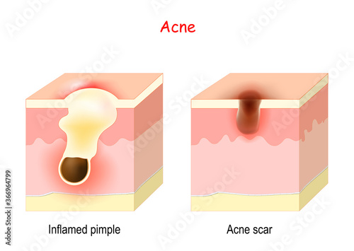 Acne treatment. Inflamed pimple and Acne scar.