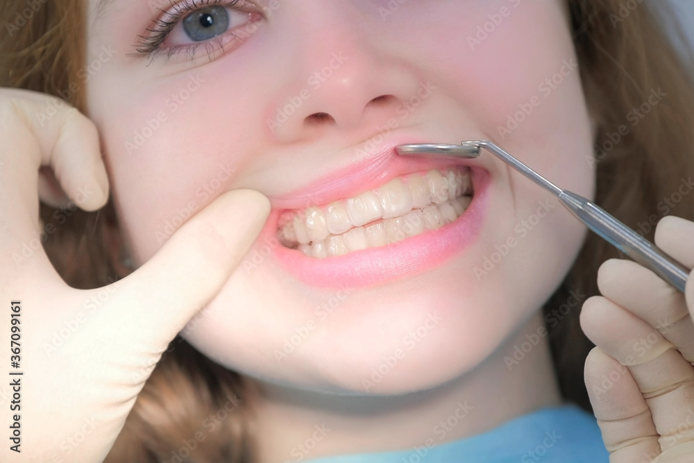 Orthodontist doctor looking with dental mirror on silicone invisible transparent braces on girl's teeth in stomatology clinic, mouth closeup view. Correcting teeth. Treatment and cure in dentistry. Orthodontist doctor looking with dental mirror on silicone invisible transparent braces on girl's teeth in stomatology clinic, mouth closeup view. Correcting teeth. Treatment and cure in dentistry.
