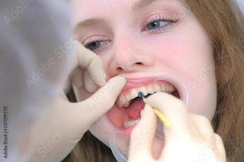 Orthodontist preparing woman teeth in dentistry before braces installing covering special gel using brush. Treatment and cure in dentistry. Portrait of girl with retractor in mouth. Correcting teeth.