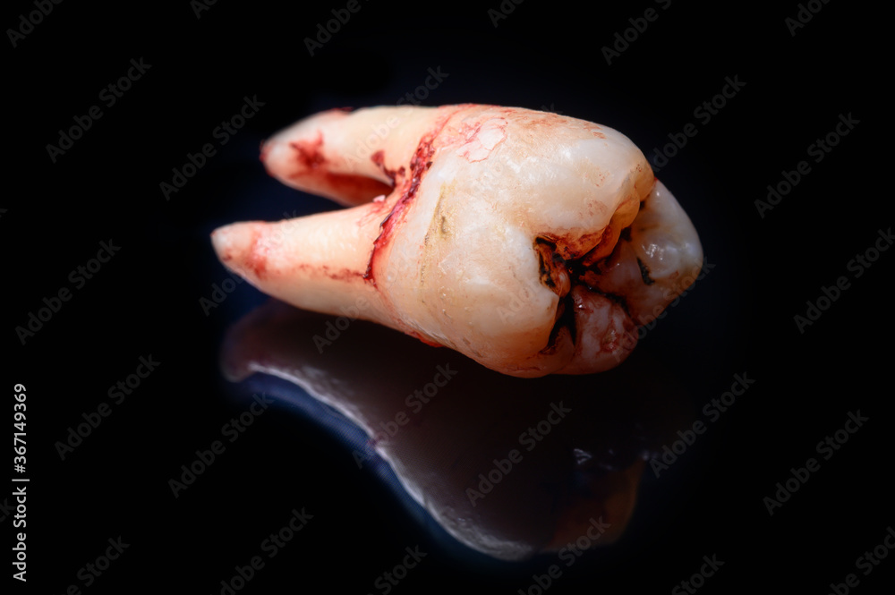 single extracted tooth with caries decay isolated on black background single extracted tooth with caries decay isolated on black background