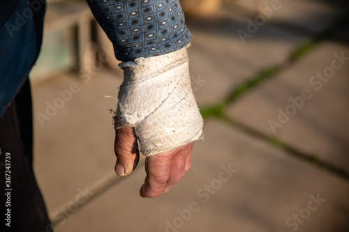 Swollen broken hand of old man in dirty white bandage