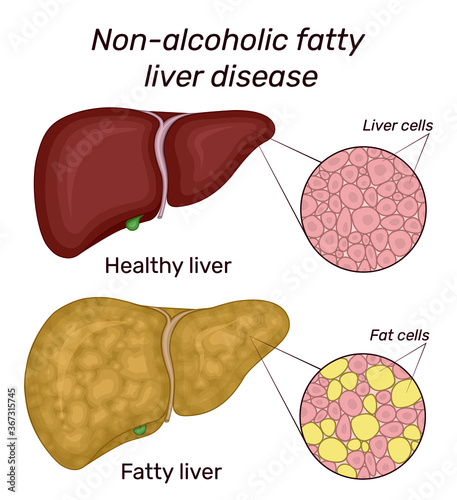 Illustration of non-alcoholic fatty liver disease. For comparison shows the healthy and diseased liver photo