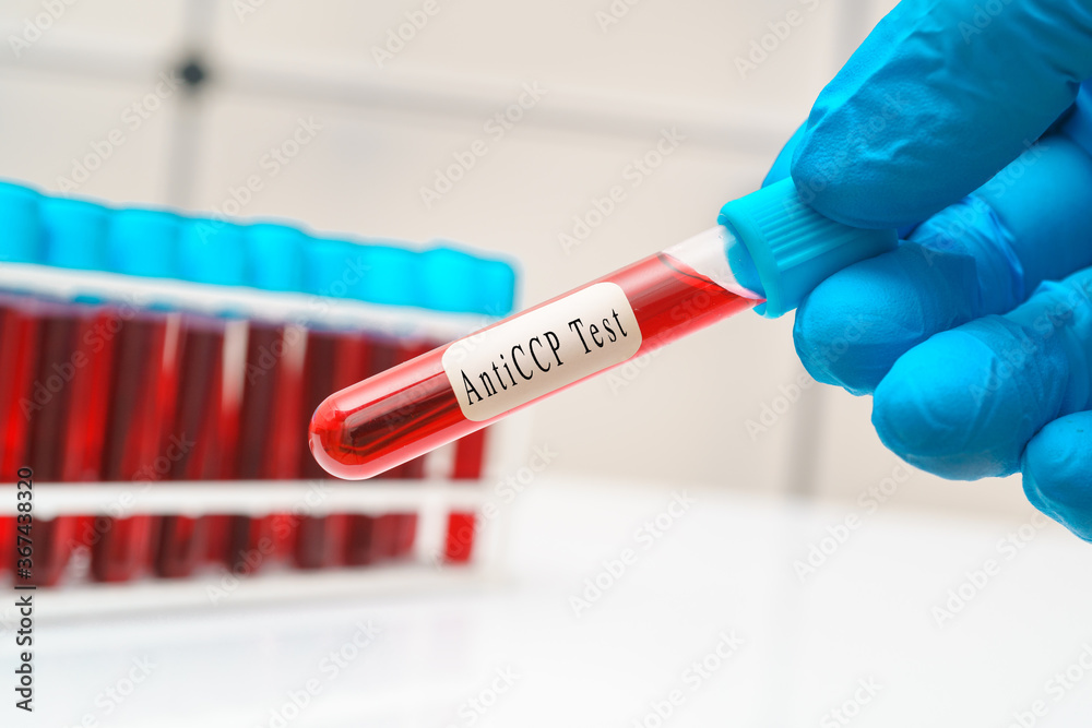 Blood sample test tube in doctor hand for anti-CCP / rheumatoid arthritis disease test Blood sample test tube in doctor hand for anti-CCP / rheumatoid arthritis disease test