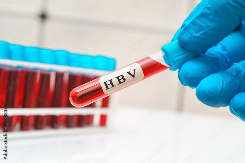 Fototapeta premium Blood sample test tube in doctor hand for hepatitis B virus HBV test
