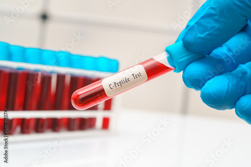 Blood sample   test tube in doctor hand for   C-Peptide  diabetes diagnosis test
